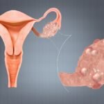 Polycystic Ovary Syndrome (PCOS): Impacts and Management