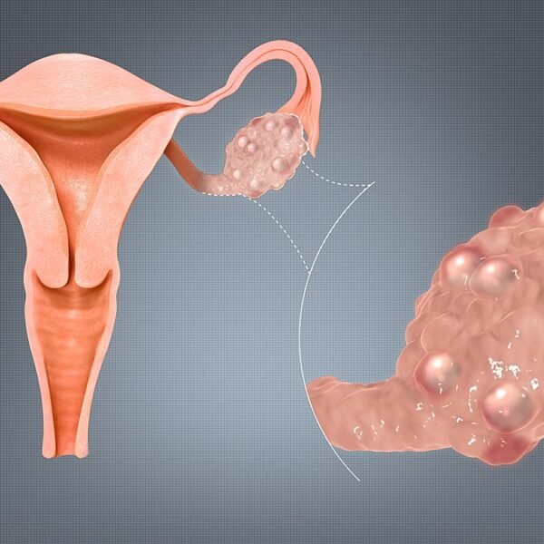 Polycystic Ovary Syndrome (PCOS): Impacts and Management